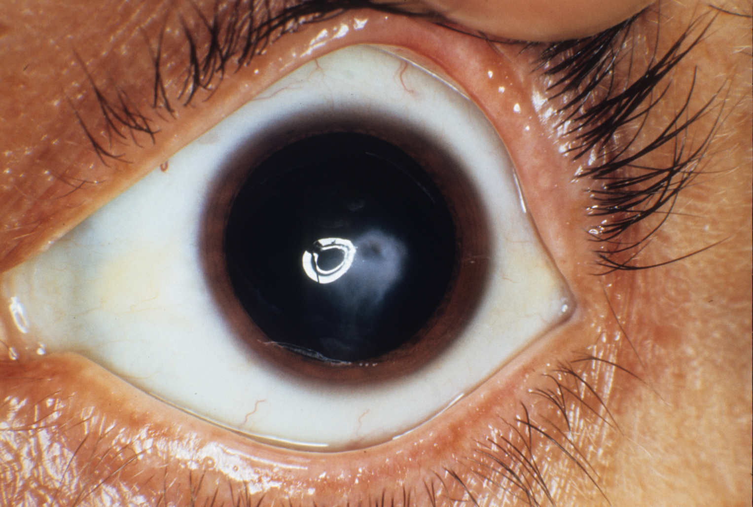 Keratoconus 1 Hereditary Ocular Diseases